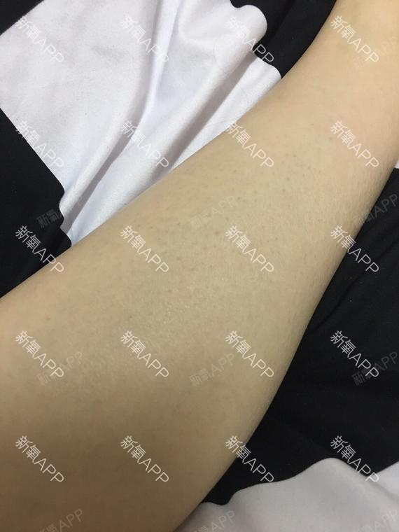 看了一眼激光脱毛仪的激光伤眼睛吗激光脱毛仪的激光是否会伤害眼睛？深入了解真相
